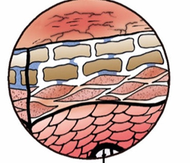 Cross-section illustration of a damaged skin barrier